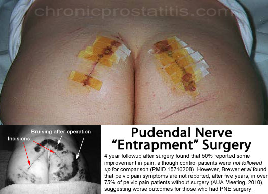 pudendal nerve entrapment #10
